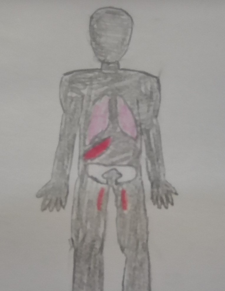An image of the organs that Metastasis prostate cancer can spread to besides the rest of the skeleton. The pink organs are lungs, and the red organ above the pelvis is the Liver, the red organs below are the lymph nodes in your thighs, where prostate cancer spreads quickly.
